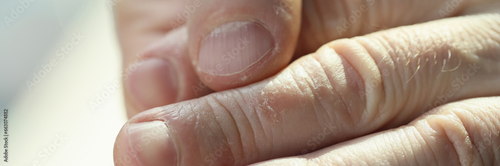Fototapeta premium Man shows eczema on skin of fingers on blurred background