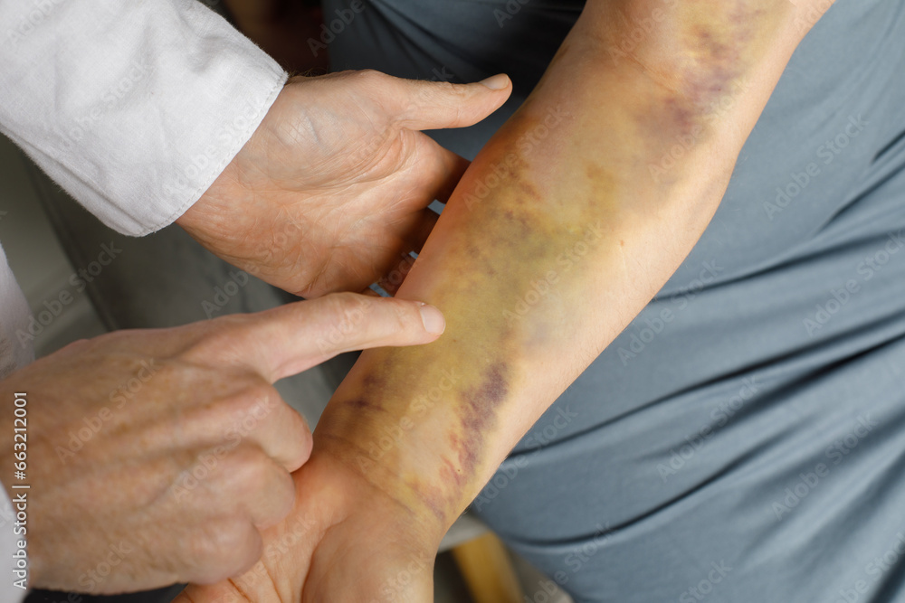 Fototapeta premium Woman with bruised hand at doctor's office