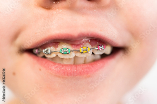 Little girl with rainbow braces