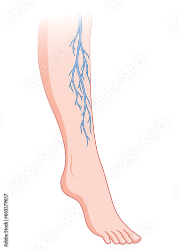 Varicose veins. Blue blood vessel visible through the skin, abnormally swollen leg. Vascular disease diagnostic and treatment. Venous insufficiency medical disease