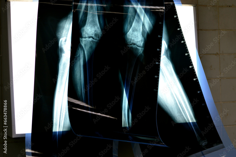 rolls of a medical case x rays before total knee replacement operation