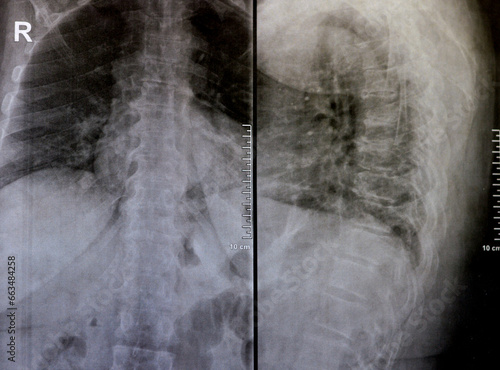 Obraz na płótnie Plain x ray of dorsal and lumber spine reveals spondylotic changes, straightenin