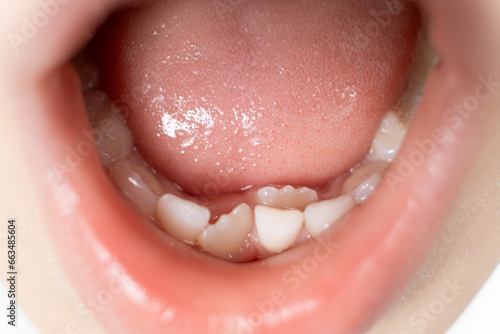 Crookedly growing teeth to replace milk teeth in a child. The second row of teeth, the tooth grows while the incisor has not yet fallen out.