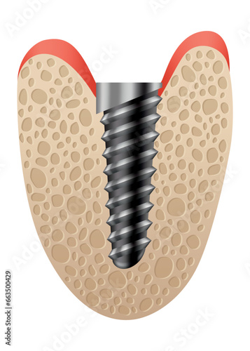 Dental implant structure. Medical educative infographic poster. Teeth implant, realistic vector design of dentistry. Implant screw, healthcare, dentist and orthodontist treatment