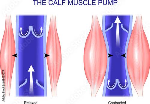 Calf muscle pump. Venous Health.