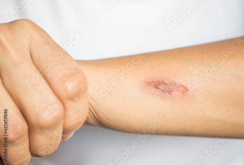 Photos Close-up of a person who received a thermal injury on their skin.