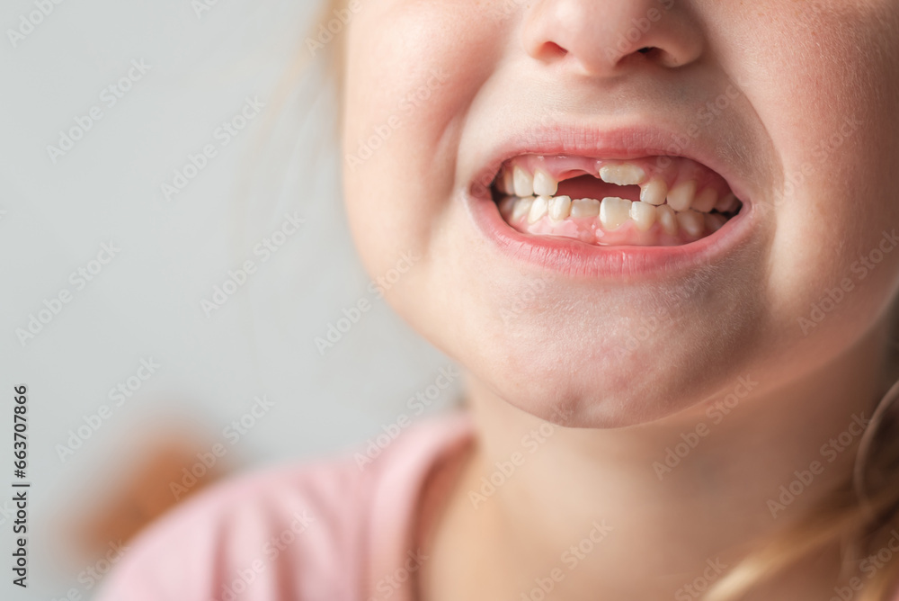 Fototapeta premium The child shows baby teeth. Pediatric dentistry and periodontology, bite correction. Close-up