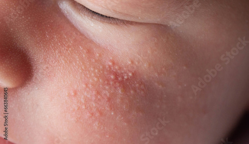 Allergic pimples in a newborn on the face. Pathogenesis, acne of newborns.