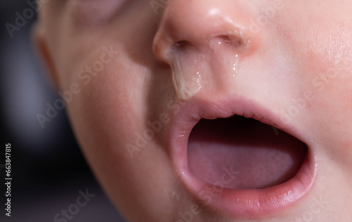 Yellow snot from a child s nose, close-up. Sinus infections, colds and virus. Chronic runny nose, adenoviruses photo