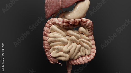 Billede på lærred Colorectal cancer, malignant tumor in intestine, Endoscope inside colonoscopy, g