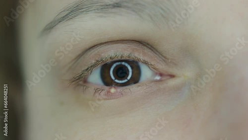 Close up of a woman eye stye. Red eye lid with onset of stye infection staphylococcal bacteria. Macro shot photo