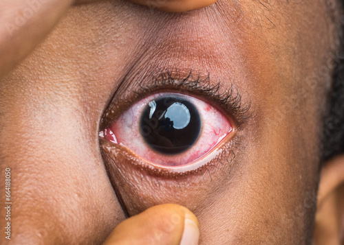 Eyes section of a face showing infectious, unhealthy, and abnormal redness of the eye which is caused by a communicable disease called conjunctivitis health condition, also known as Apollo in Nigeria,