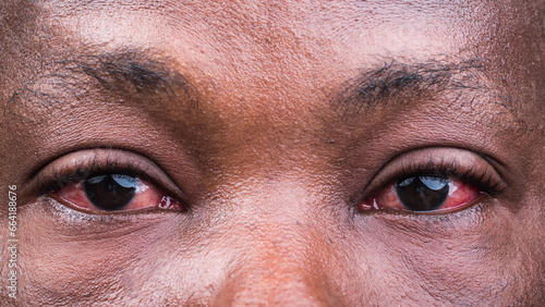 Eyes section of a face showing infectious, unhealthy, and abnormal redness of the eye which is caused by a communicable disease called conjunctivitis health condition, also known as Apollo in Nigeria,