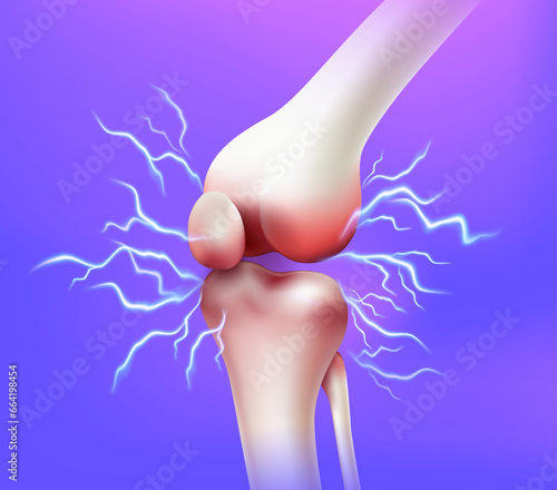 Knee joint pain and tendon problems, side view Inflammatory disease of the knee joint. Realistic 3D vector file.