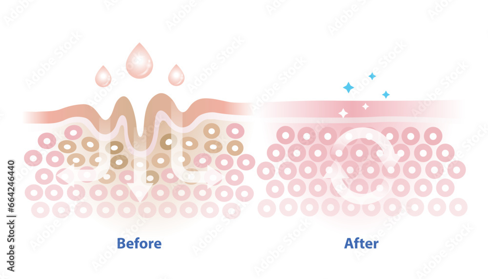 Before and after skincare absorption vector illustration isolated on white background. Cross section of wrinkles skin and skincare absorbing to help reduce aging and damaged skin. Skin care concept.
