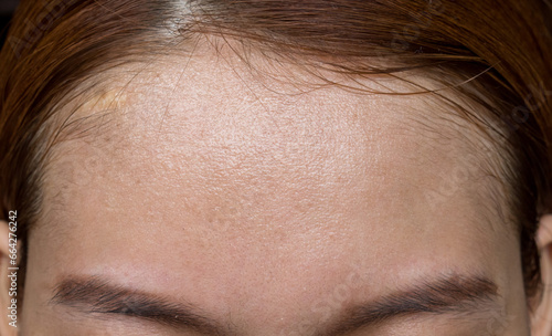 Oily skin of wide forehead of Asian adult young woman. photo