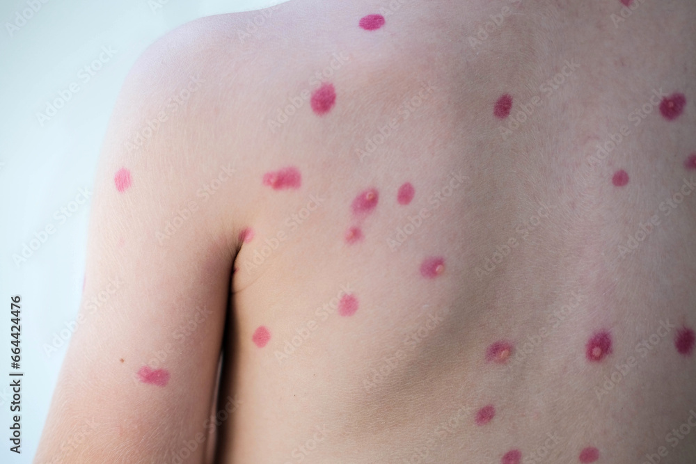 Treatment of ulcers from chickenpox, chickenpox with a healing cream on the skin of a child. Close-up of a child's back treated with red medicine. - obrazy, fototapety, plakaty 