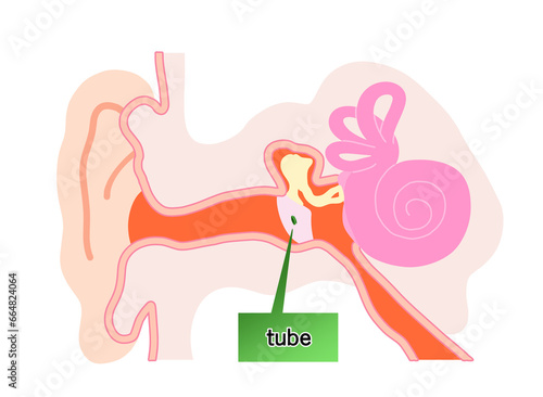 鼓膜にチューブが刺さっている状態のシンプルなイラスト photo