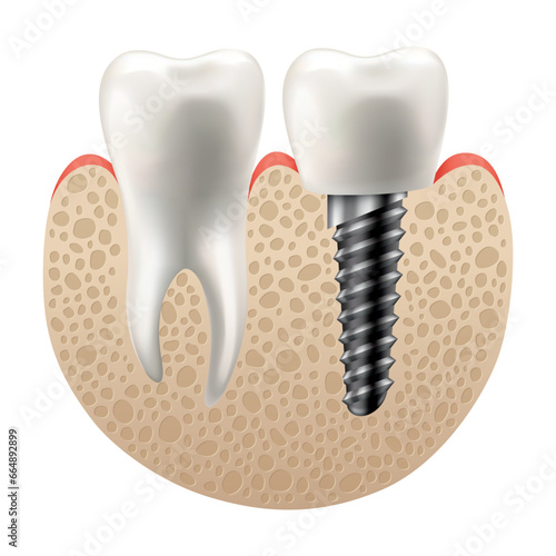 Dental implant structure. Medical educative infographic poster. Teeth implant, realistic vector design of dentistry. Implant screw, healthcare, dentist and orthodontist treatment