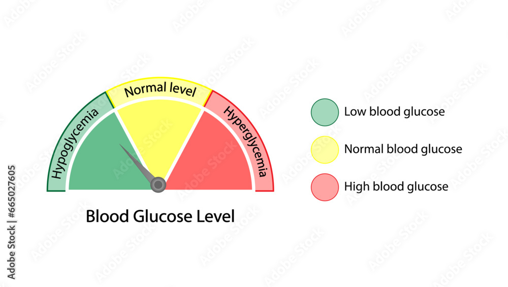 Blood Glucose Levels. Normal level, hypoglycemia (low blood sugar