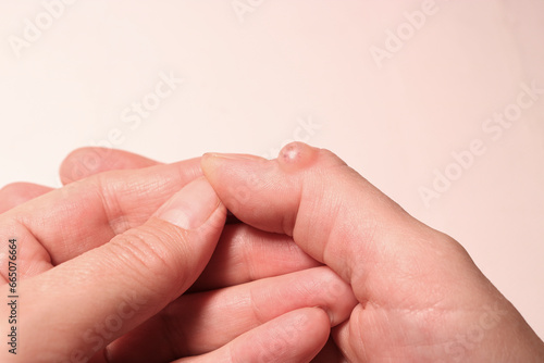 Female hand with hygroma of the thumb. Selective focus.