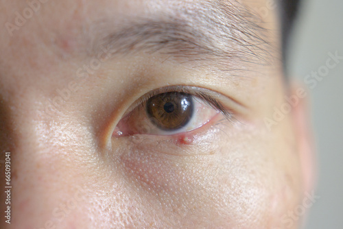 Close up eye brown with stye infection. Eyelid abscess, hordeolum in medical health. photo