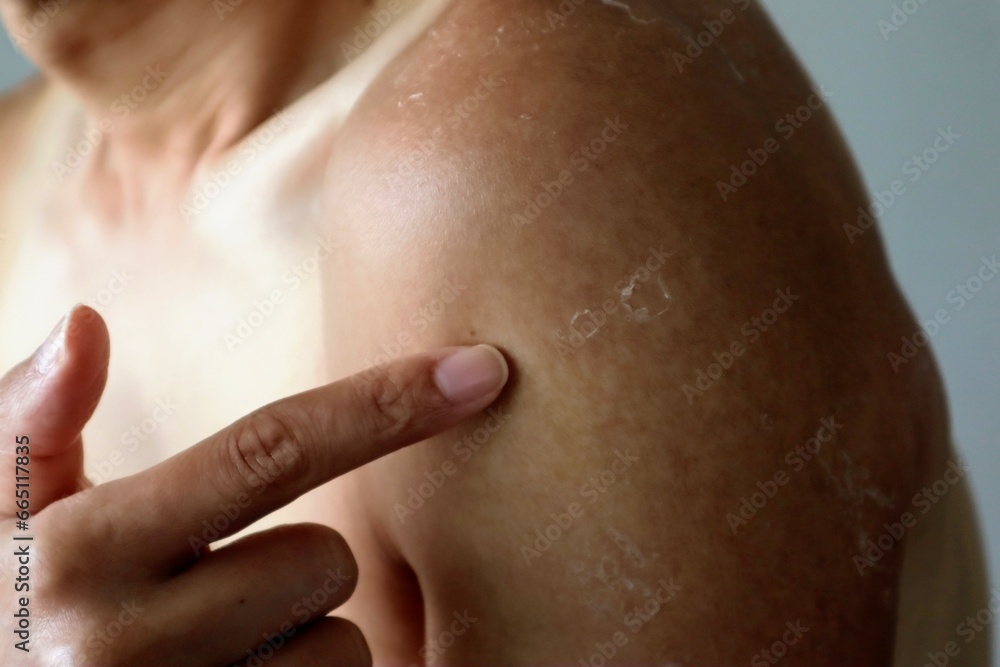 Fototapeta premium 日焼けした肌を指差す人物