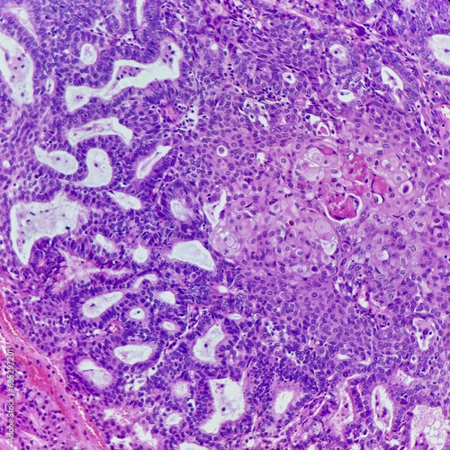 Camera photo of endometrioid carcinoma with squamous differentiation, magnification 200x, photograph through a microscope