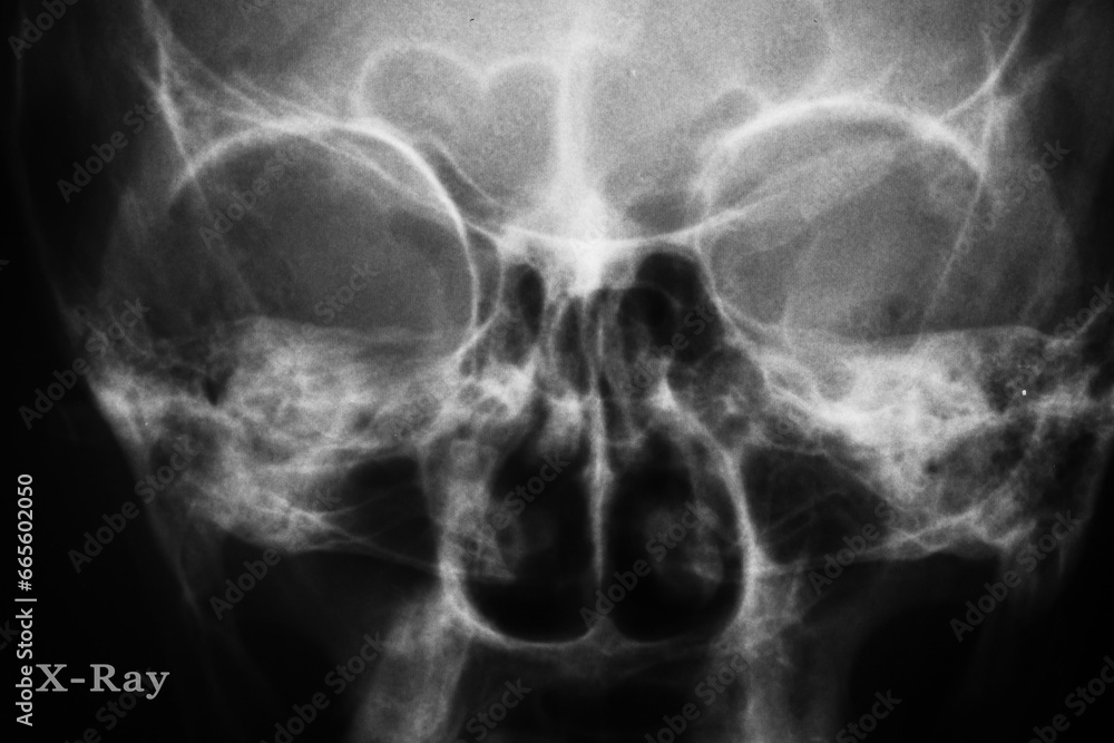x ray image of human skull x ray image of human skull