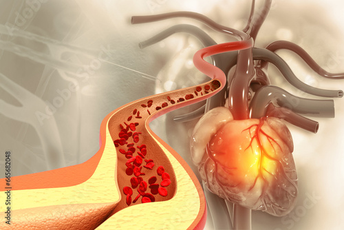 Wall Mural Cholesterol blocked artery