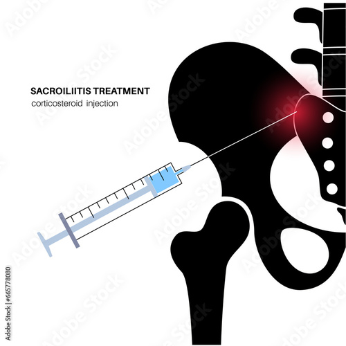 Sacroiliitis corticosteroid injections