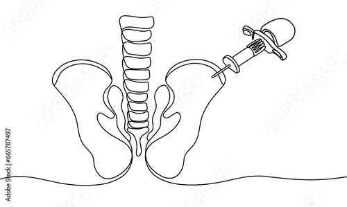 Puncture of the bone marrow. One line