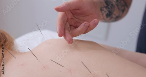 acupuncture therapy on spine, shoulders for female client. girl undergoing acupuncture treatment with fine needles inserted into slim body skin in clinic hospital, lying on couch Slow motion Close up