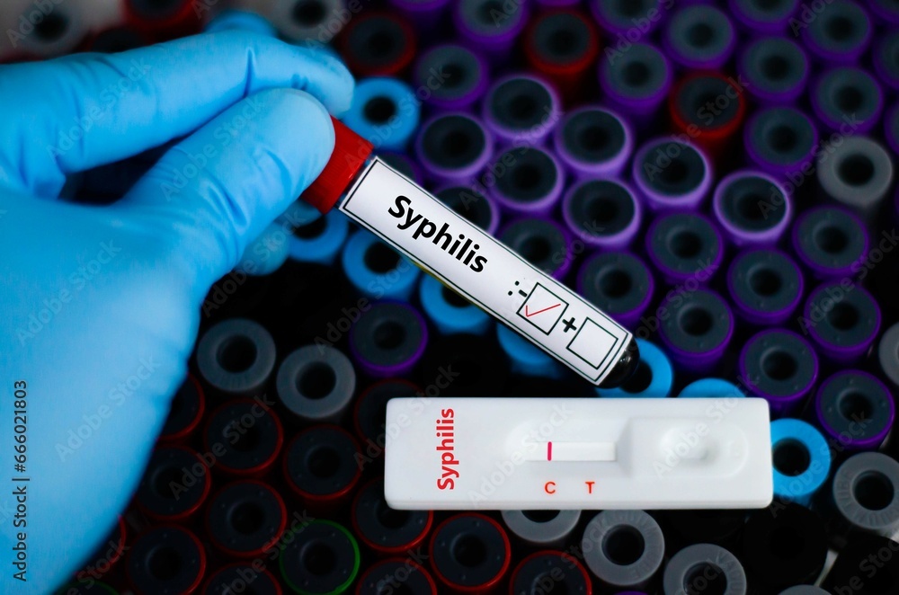 Obraz premium The patient negative for syphilis by rapid diagnostic test.