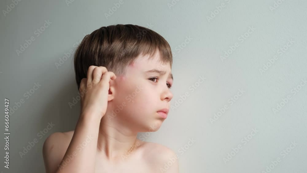 The boy looking at the camera rubbing and scratching head with a swollen eye from an insect bite. Close-up view. Angioedema. Allergic response. Red inflamed upper eyelid. Inflammation. Itching bites The boy looking at the camera rubbing and scratching head with a swollen eye from an insect bite. Close-up view. Angioedema. Allergic response. Red inflamed upper eyelid. Inflammation. Itching bites