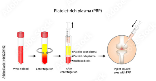 Platelet-rich plasma (prp). Autologous conditioned plasma, is a concentrate of PRP extracted from whole blood. After centrifugation, extract PRP and inject knee. Vector Illustration.