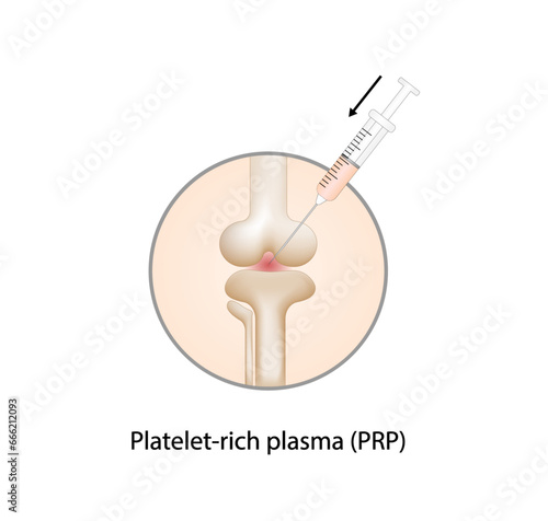 Platelet-rich plasma (prp). Autologous conditioned plasma, is a concentrate of PRP extracted from whole blood. After centrifugation, extract PRP and inject knee. Vector Illustration.