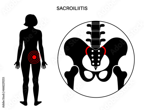 Sacroiliitis medical poster