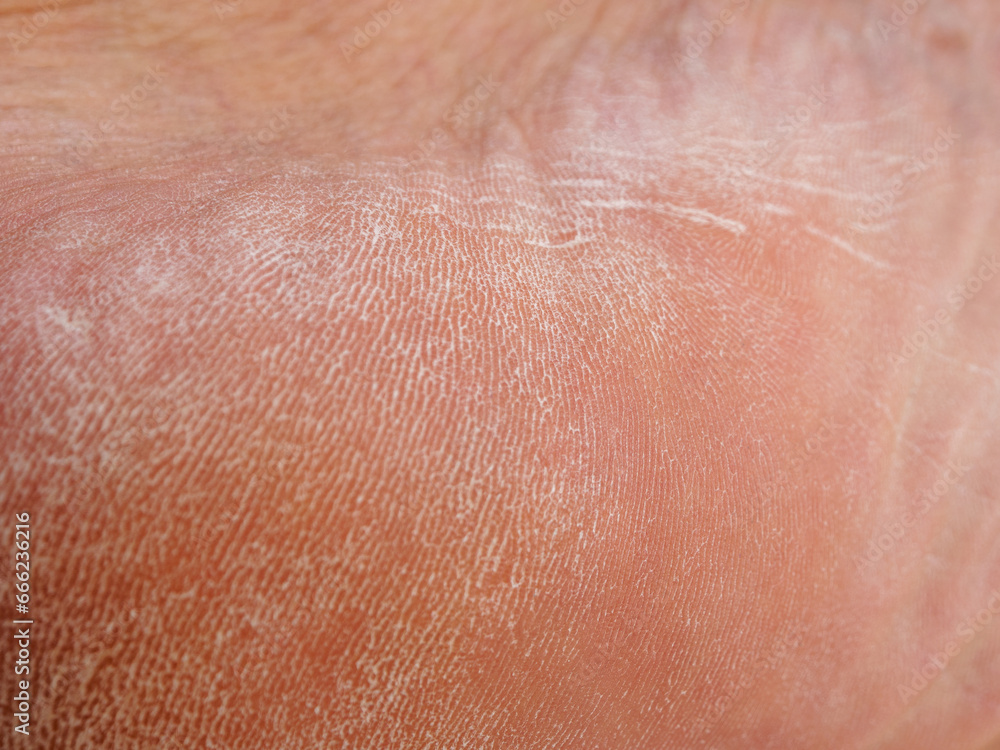 Dry skin damaged macro shot of the surface Dry skin damaged macro shot of the surface