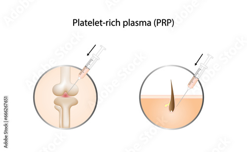 Platelet-rich plasma (prp). Autologous conditioned plasma, is a concentrate of PRP extracted from whole blood. After centrifugation, extract PRP and inject hair, skin or knee. Vector Illustration