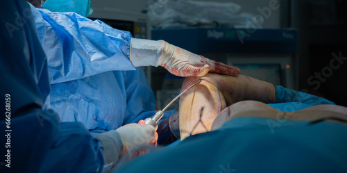 doctor doing arm liposuction. The arm is thinned with arm liposuction. Plastic surgery. photo