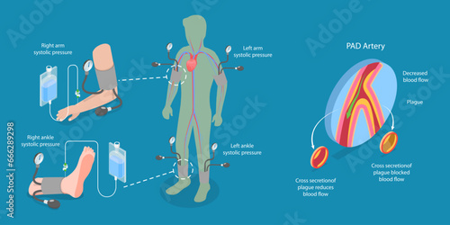 3D Isometric Flat Vector Illustration of ABI Test, Limb Ischemia Diagnosis
