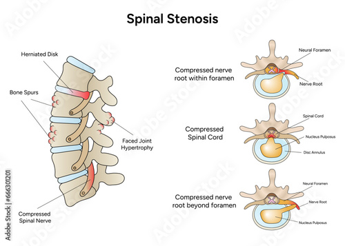 Spinal stenosis medical infographic cartoon in vector