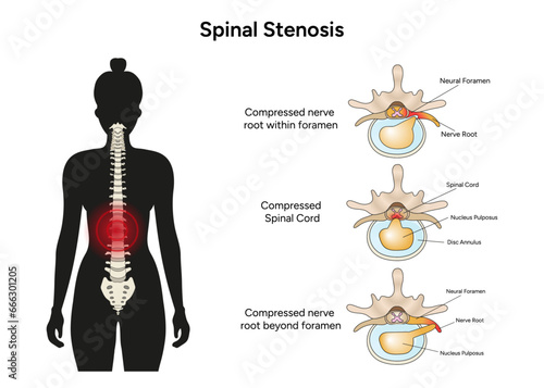 Spinal stenosis medical infographic in vector photo