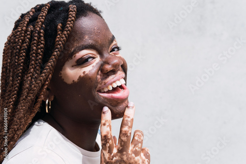 Happy young woman with vitiligo and depigmentation in front of white wall photo