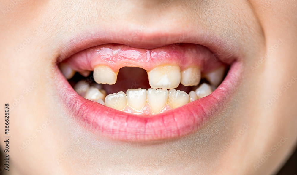 Child bad teeth. Boy kid lost front tooth, toothache. Child without one front tooth. No teeth. Yellow teeth. Bad dental health, no teeth, no fluoride, tooth erosion. Portrait boy with bad teeth Child bad teeth. Boy kid lost front tooth, toothache. Child without one front tooth. No teeth. Yellow teeth. Bad dental health, no teeth, no fluoride, tooth erosion. Portrait boy with bad teeth
