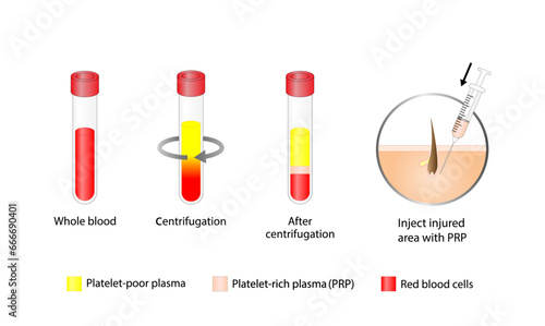 Platelet-rich plasma (prp). Autologous conditioned plasma, is a concentrate of PRP extracted from whole blood. After centrifugation, extract PRP and inject skin or hair. Vector Illustration.