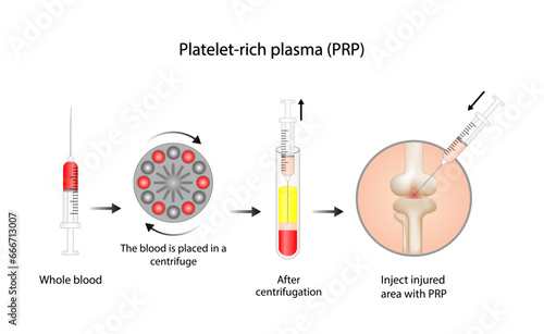 Platelet-rich plasma (prp). Autologous conditioned plasma, is a concentrate of PRP extracted from whole blood. After centrifugation, extract PRP and inject knee. Vector Illustration