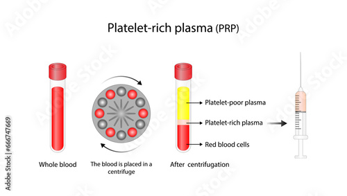 Platelet-rich plasma (prp). Autologous conditioned plasma, is a concentrate of PRP extracted from whole blood. After centrifugation, extract PRP and inject hair, skin or knee. Vector Illustration photo