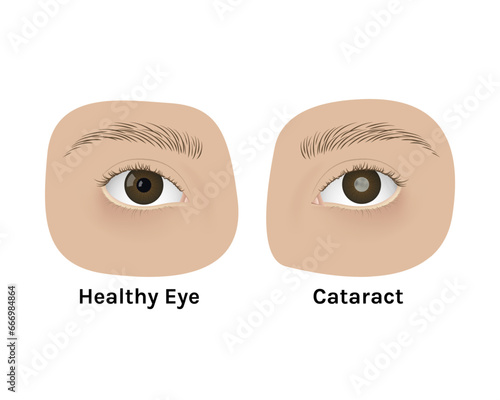 Realistic human healthy eye and with cataract vector illustration design.